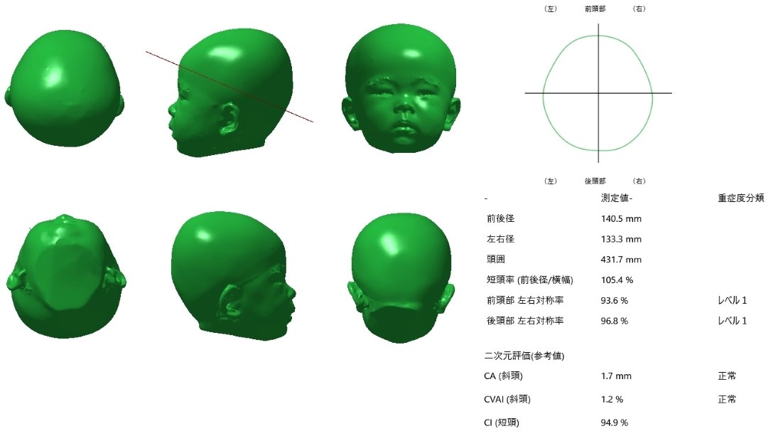 赤ちゃんの頭の形を3Dで評価する検査イメージ 赤ちゃんの頭部形状を3Dスキャンで可視化した検査イメージ。左右差や前後バランスの評価に使用